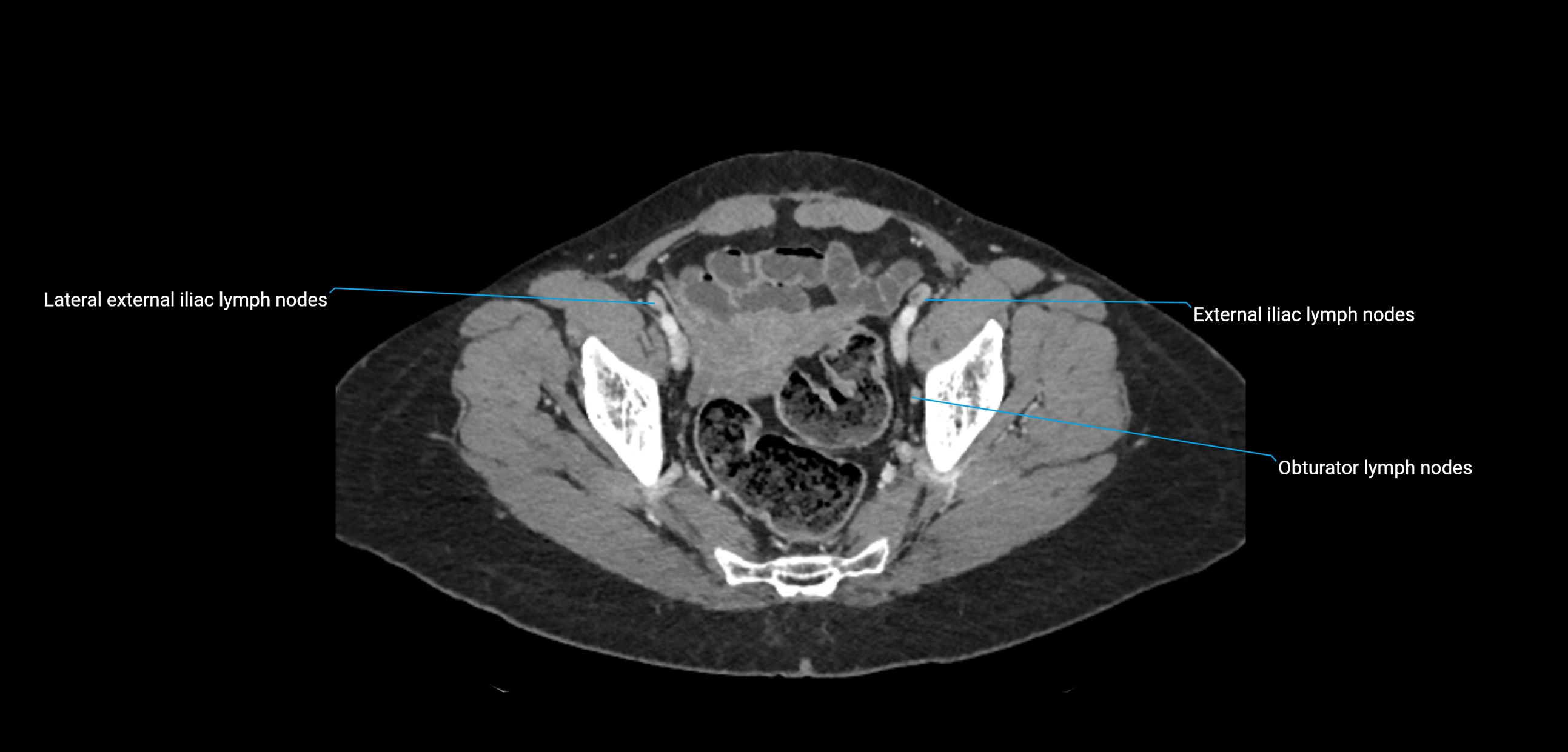 CT ct abdominal lymph nodes  axial cross sectional anatomy  enchanced radiology image -img-00002-00361.webp
